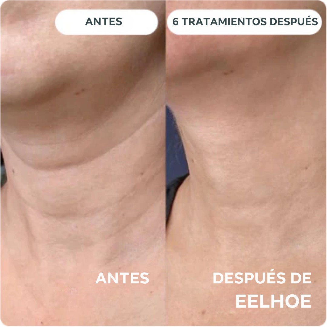 Eelhoe - Sistema de Micro Infusión