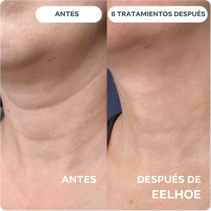 Eelhoe - Sistema de Micro Infusión