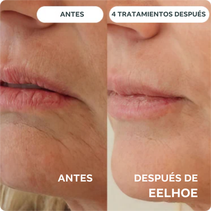 Eelhoe - Sistema de Micro Infusión