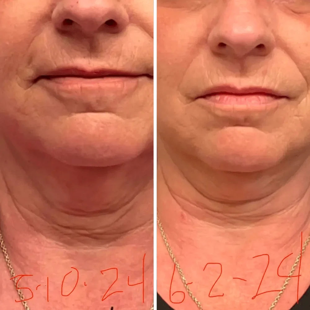 Crema para cuello - Antiedad