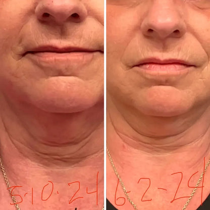Crema para cuello - Antiedad