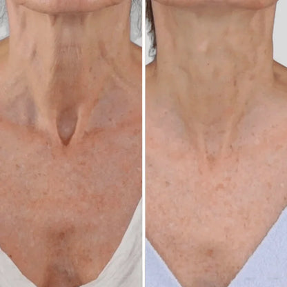 Crema para cuello - Antiedad