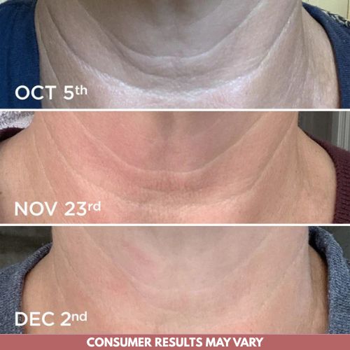 Crema para cuello - Antiedad